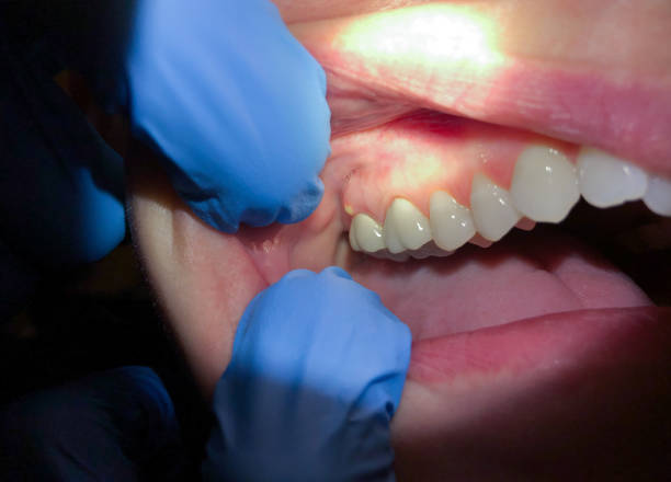 Best Emergency Treatment for Dental Infections or Abscesses in Emigsville, PA